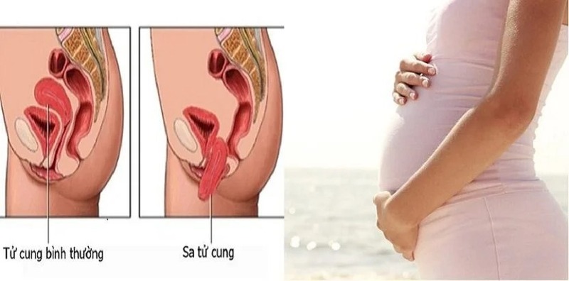bi-sa-tu-cung-co-mang-thai-duoc-khong-1