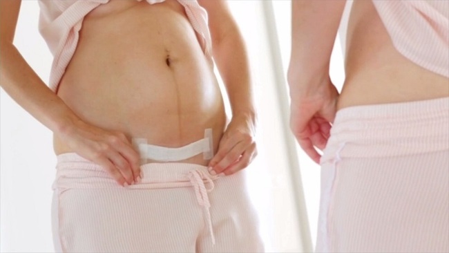 Cách chăm sóc vết sẹo sinh mổ đúng cách 