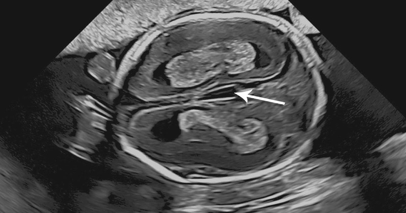 cach-tinh-chu-ky-mang-thai-4