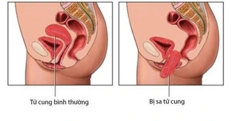 dau-hieu-bi-sa-tu-cung-sau-sinh​-3