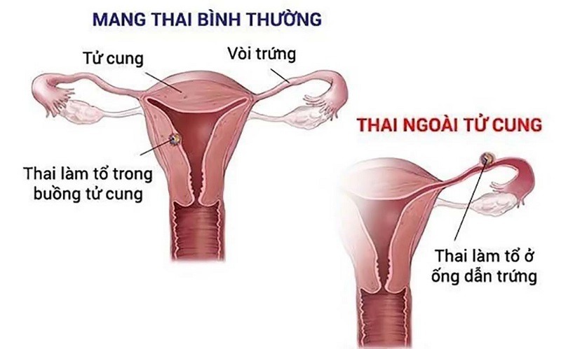 mang-thai-ngoai-tu-cung-co-nguy-hiem-khong​-1
