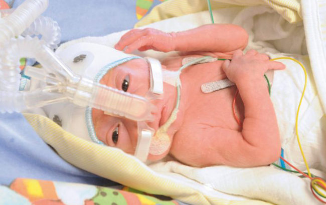 Nguyên nhân sinh non mà mẹ cần biết để ngăn ngừa rủi ro