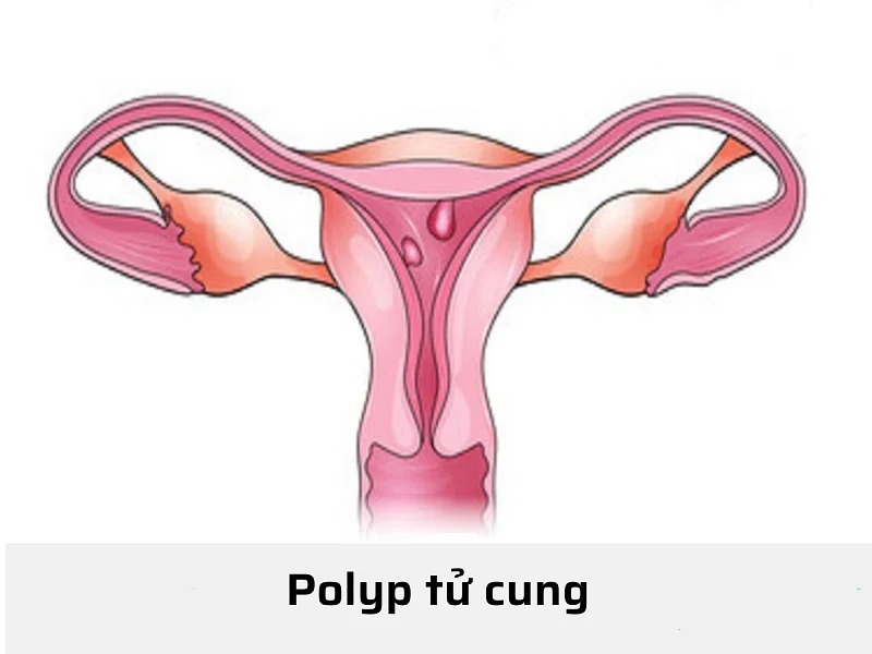 polyp-tu-cung-co-mang-thai-duoc-khong​-1
