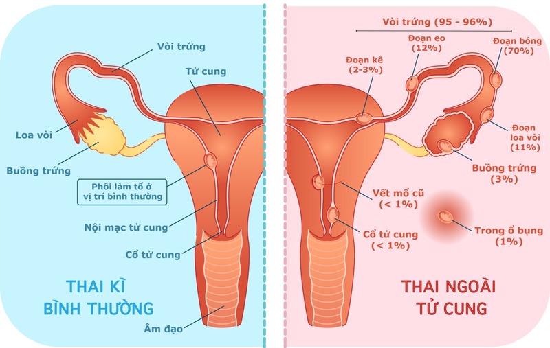 thai-ngoai-tu-cung-bao-lau-thi-sieu-am-thay​-1
