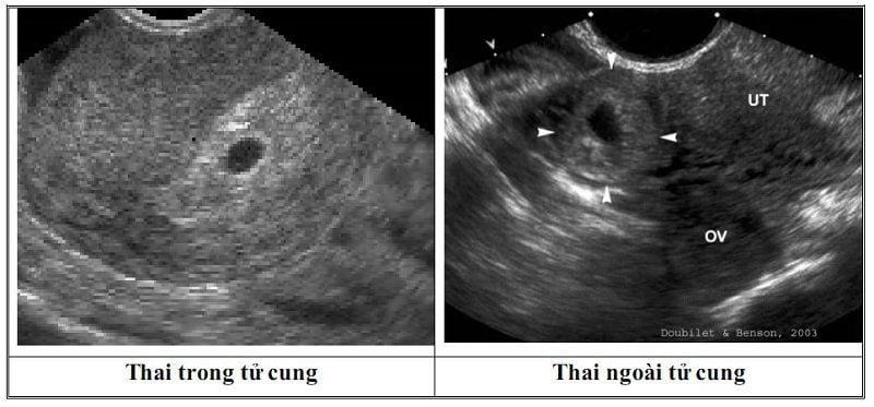 thai-ngoai-tu-cung-bao-lau-thi-sieu-am-thay​-3